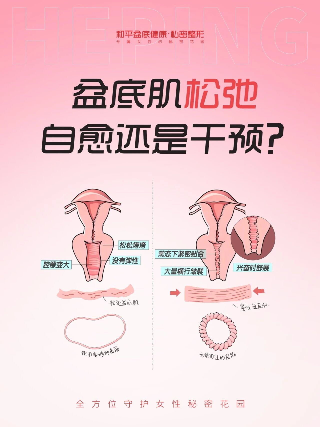 盆底肌可以自愈？还是需要干预？